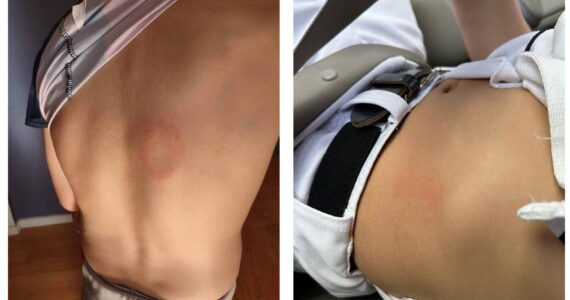 These photos show bruises on Rainier Middle School players. (Courtesy of Auburn Police Department)
