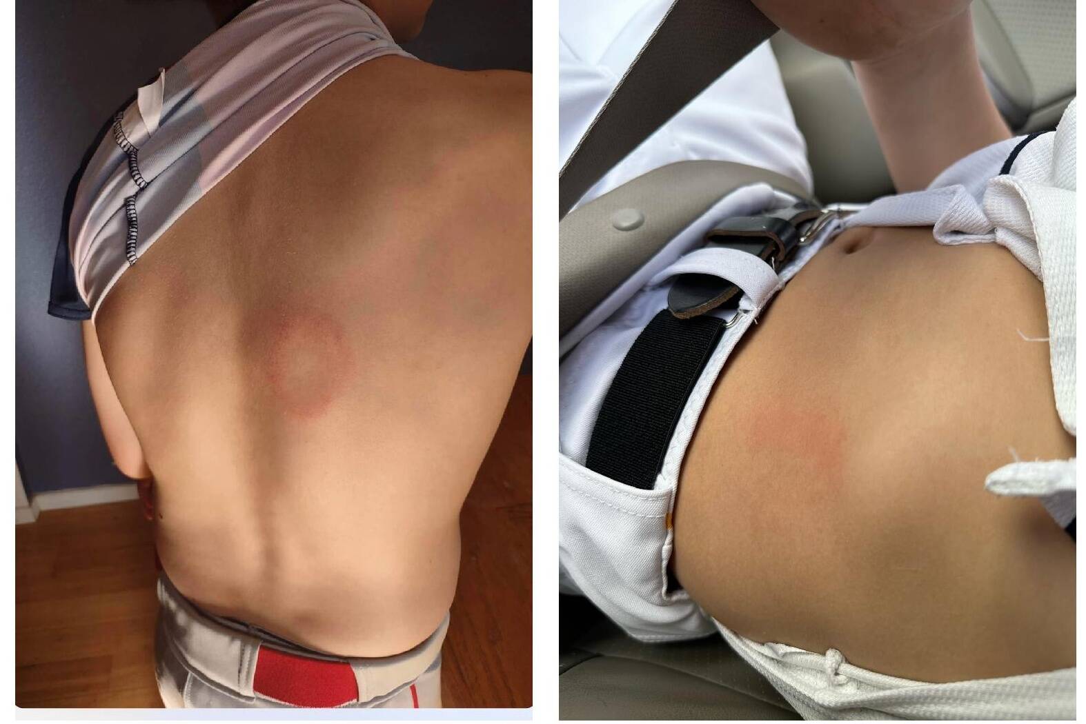 These photos show bruises on Rainier Middle School players. (Courtesy of Auburn Police Department)