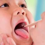 Officials: 3 confirmed cases of mumps in Auburn