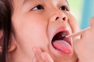 Officials: 3 confirmed cases of mumps in Auburn