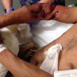 An image of Urbano Velazquezs arm after he was bitten by a King County Sheriffs Office K-9. It has been cropped to remove Velazquezs face. File photo