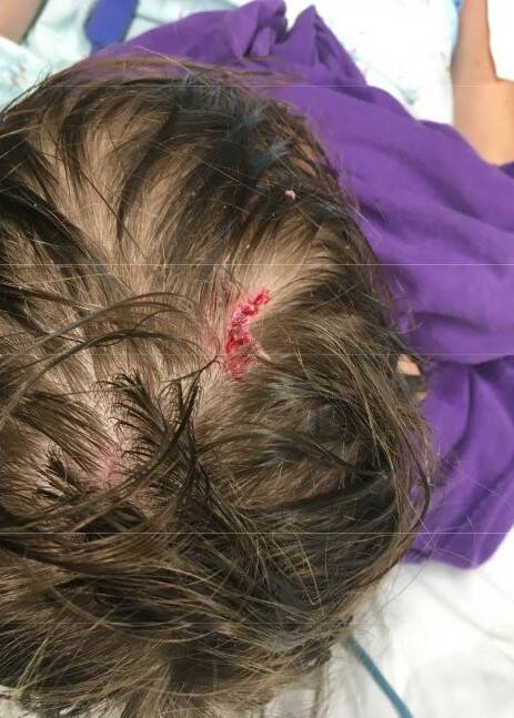 Injuries as a result of K9 Jax. (Photo from the Auburn Police Department)