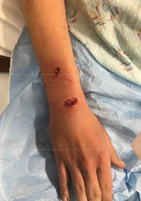 Injuries as a result of K9 Jax. (Photo from the Auburn Police Department)