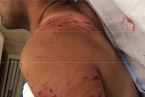 On July 4, 2017, Auburn Police Officer Timothy Nunn initiated a K9 track on Elmer Gomez-Evaristo after he fled from a hit-and-run that resulted in injuries to a woman. The K9 attacked Gomez-Evaristo after discovering him lying on his back, resulting in his hospitalization. (Photos courtesy of Auburn Police Department)